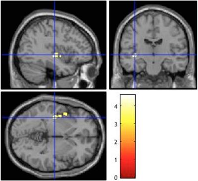 Altered Insular Function during Aberrant Salience Processing in Relation to the Severity of Psychotic Symptoms